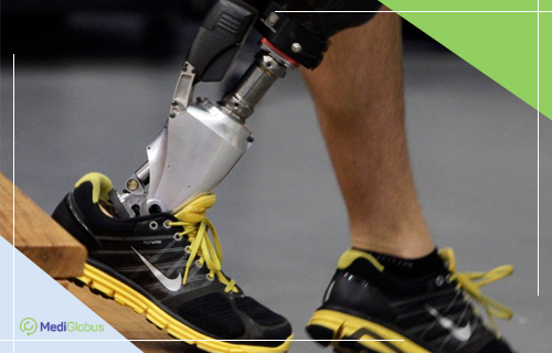 Бионический протез ноги