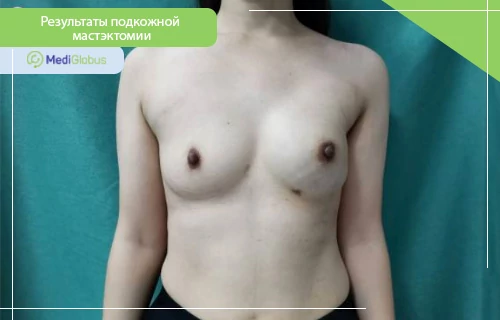 Фотография результата после подкожной мастэктомии