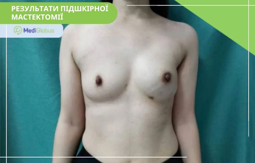 Ендоскопічна мастектомія молочної залози Фотографія результату після підшкірної мастектомії