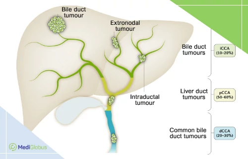 intrahepatic cholangiocarcinoma