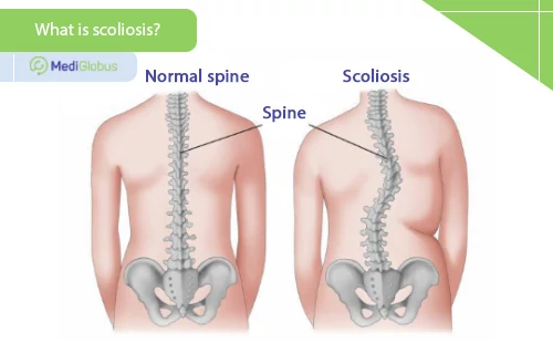 what is scoliosis?