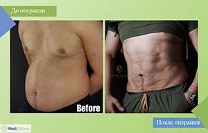 пластика мышц живота