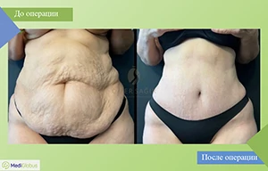 абдоминопластика за рубежом