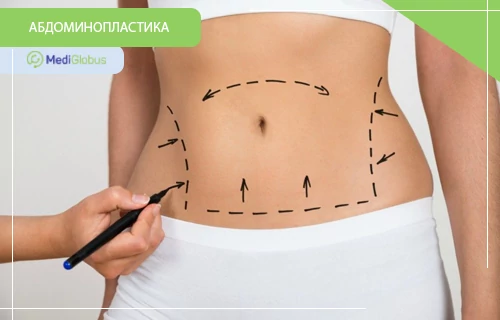Абдоминопластика за рубежом