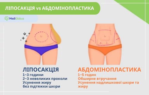 Порівняння ліпосакції та абдомінопластики Інфографіка: Порівняння ліпосакції та абдомінопластики