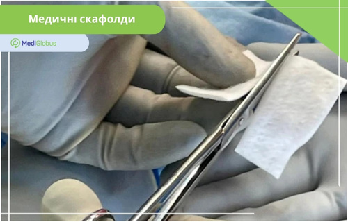 Застосування скафолдів при травмах м’язів Медичний працівник у сірих рукавичках розрізає ножицями білий пористий матеріал (медичний скафолд) на операційному столі.