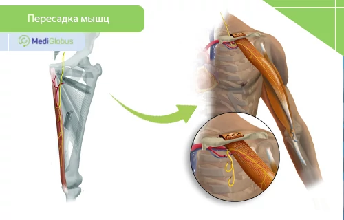трансплантация мышц