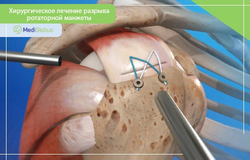 восстановление мышц операция