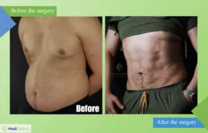 six-pack surgery of Dr. Ömer Sağır