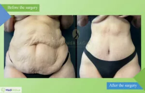 tummy tuck in the clinic of Dr. Ömer Sağır