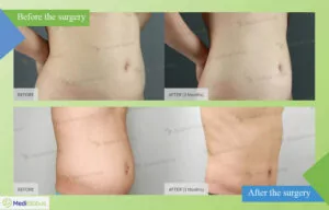 Liposuction at JK Clinic
