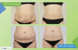 Abdominoplasty at ID Clinic