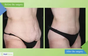 Abdominoplasty in Estetik International