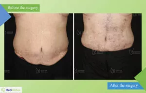 Abdominoplasty in Estetik International