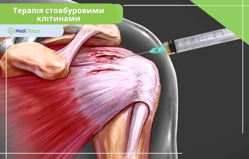 Лікування травми м’язів стовбуровими клітинами Медична ілюстрація процесу лікування м’язів плеча стовбуровими клітинами. Шприц вводить ін’єкцію безпосередньо в ділянку пошкодженої м’язової тканини.