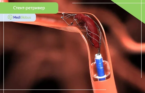 стент ретривер при инсульте