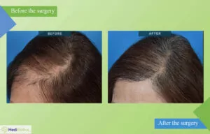 female hair transplant