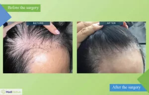 hair transplant for women