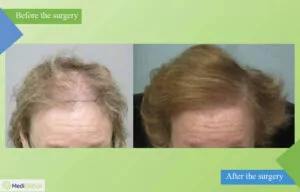 hair transplant for women