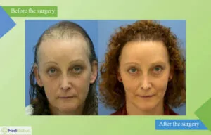 hair transplant for women