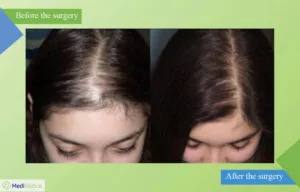 hair transplant for women