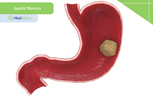 gastric fibroma