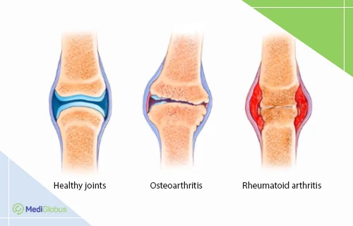 joint diseases