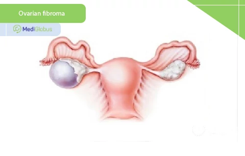 ovarian fibroma