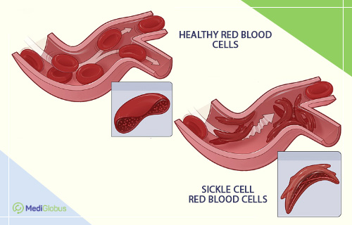 sickle cell aenemia