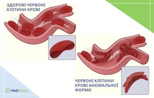 Медична ілюстрація, на якій порівнюються здорові круглі еритроцити та деформовані серпоподібні клітини у кровоносних судинах. Зліва зображено вільний кровотік, праворуч — блокування судини клітинами аномальної півмісяцевої форми.