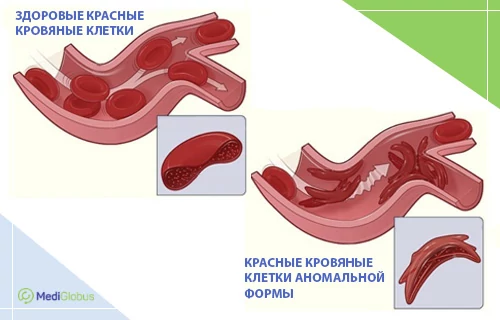 Что такое серповидноклеточная анемия Медицинская иллюстрация, сравнивающая здоровые круглые эритроциты и деформированные серповидные клетки в кровеносных сосудах. Слева показан свободный кровоток, справа — блокировка сосуда клетками аномальной полулунной формы.