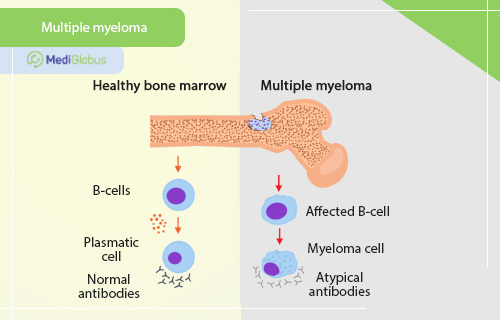 bone marrow in multiple myeloma
