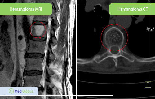 haemangioma of a vertebrae ct and mri