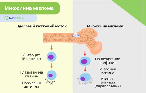 Медична інфографіка, в якій порівнюються здоровий кістковий мозок та розвиток множинної мієломи.