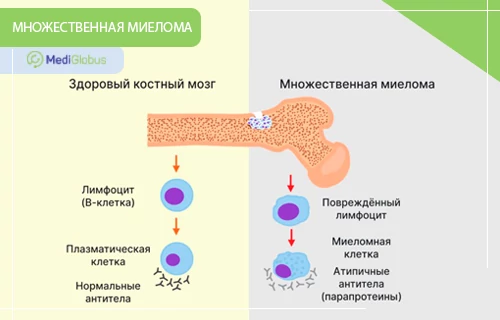 Что такое множественная миелома Медицинская инфографика, сравнивающая здоровый костный мозг и развитие множественной миеломы.
