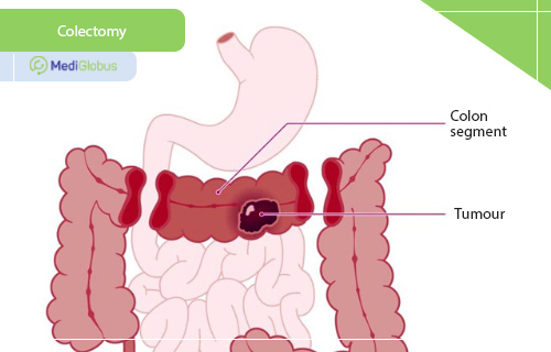 large intestine cancer surgery
