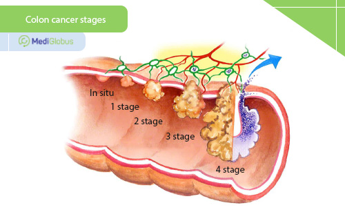 colon cancer treatment by stages