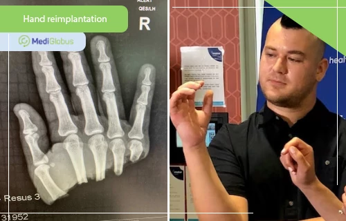 hand reimplantation