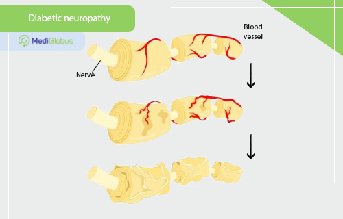 diabetic neuropathy