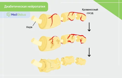 Инфографика, демонстрирующая этапы развития диабетической нейропатии на примере повреждения нервного волокна. Сверху вниз показаны три стадии: от здорового состояния с нормальным кровоснабжением через постепенное разрушение кровеносных сосудов до полной дегенерации и истончения ткани нерва.