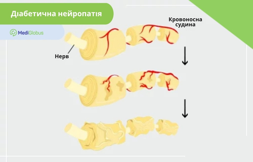 Інфографіка, що ілюструє етапи розвитку діабетичної нейропатії на прикладі ушкодження нервового волокна. Зверху вниз показано три стадії: від здорового стану з нормальним кровопостачанням через поступове руйнування кровоносних судин до повної дегенерації та витончення нервової тканини.