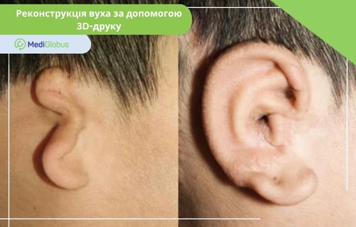 3D-друк вуха Результат реконструкції зовнішнього вуха (вушної раковини) при мікротії; ліворуч — деформоване вухо пацієнта до операції, праворуч — відновлене вухо після хірургічного втручання