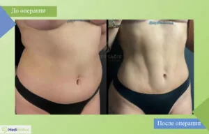 Липосакция в клинике доктора Омера Сагира Фотографии до и после липосакции