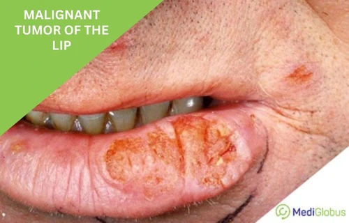 Rak-gybu-lechenie-en Cancer of the lip