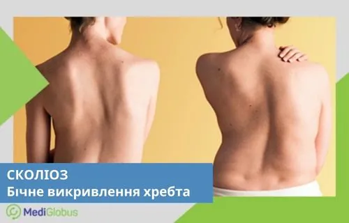 Дві фотографії спини з різним ступенем викривлення хребта