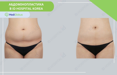 Абдомінопластика в Південній Кореї, клініка ID Hospital Фотографії до та після абдомінопластики у клініці АйДі Хоспітал