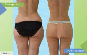 Липосакция в клинике Aestetic Center Фотографии до и после липосакции