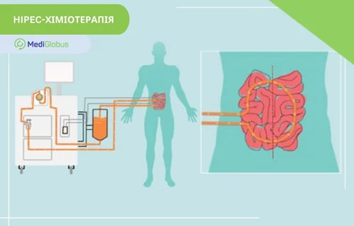 HIPEC-хіміотерапія при раку апендикса Схема проведення HIPEC-хіміотерапії