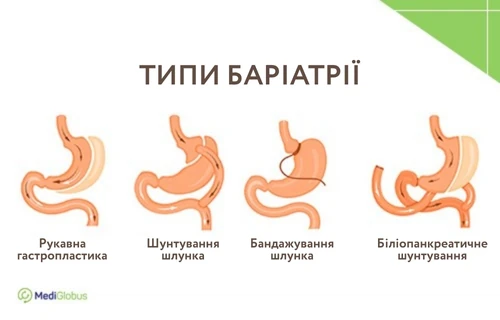 Методи баріатричної хірургії схематичні зображення типів баріатричних операцій: рукавна гастропластика, шунтування шлунка, бандажування, біліопанкреатичне шунтування