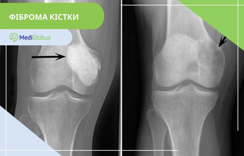Як виглядає фіброма кістки на рентгені Фіброма кістки: фото на рентгені